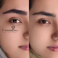 میکروبلیدینگ ابرو فیبروز،ریموو تک جلسه ای تتو