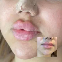 ژل و بوتاکس|خدمات آرایشگری و زیبایی|کارون, |دیوار