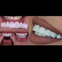 دندان و لمینت