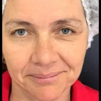 جشنواره  تخفیف جراحی لیفت صورت