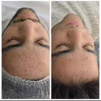 فیشال تخصصی صورت وایتنینگ بدن در کلینیک زیرنظرپزشک|خدمات آرایشگری و زیبایی|اسلامشهر, باغ فیض|دیوار