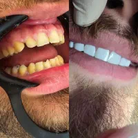 کامپوزیت/دندان