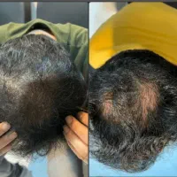 قطع ریزش مو در ۲۱ روز