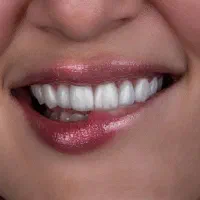 ایمپلنت8 تومن/کامپوزیت2تومن/عصب کشی/لمینت|خدمات آرایشگری و زیبایی|مشهد, سجاد شهر|دیوار