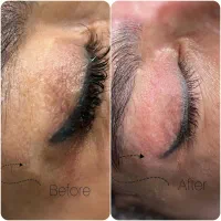 رفع اسکار بلفاروپلاستی بدون بازگشت|خدمات آرایشگری و زیبایی|اصفهان, چشمه باقرخان|دیوار