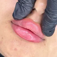 جشنواره تزریق ژل و بوتاکس