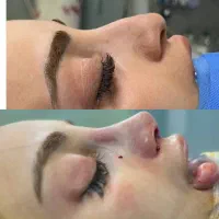 عمل جراحی بینی با ۵۰٪تخفیف ویژه فرصت محدود|خدمات آرایشگری و زیبایی|اصفهان, نقش جهان|دیوار