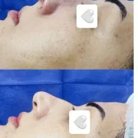 بلفاروپلاستی تیپ پلاستی ساکشن