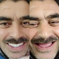دندانسازی،دندان مصنوعی،جوان پسند،اقساطی با چک