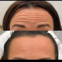 بوتاکس وفیلر صورت و بدن|خدمات آرایشگری و زیبایی|بیرجند, |دیوار