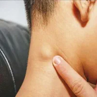 رفع غده های زیرپوستی|خدمات آرایشگری و زیبایی|خمینی‌شهر, |دیوار