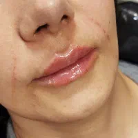 تزریق ژل / بوتاکس|خدمات آرایشگری و زیبایی|اردبیل, |دیوار