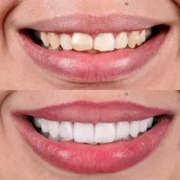 لبخندی رویایی با متریال برند های برتر کامپوزیت|خدمات آرایشگری و زیبایی|یاسوج, |دیوار