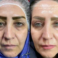 جشنواره بلفاروپلاستی پلک غبغب سانترال ژل چربی|خدمات آرایشگری و زیبایی|قم, بلوار امین و ساحلی|دیوار