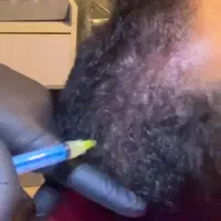 بوتاکس ،پی آر پی  و فیلر