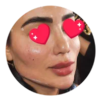 جشنواره بوتاکس مصپورت ۶۵۰فیلر ۶۹۰ فقط تا آخر آبان|خدمات آرایشگری و زیبایی|اصفهان, شمس آباد|دیوار