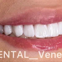 کامپوزیت دندان   تکنیک لیرینگ    لمینت ( اقساط)|خدمات آرایشگری و زیبایی|تهران, قیطریه|دیوار