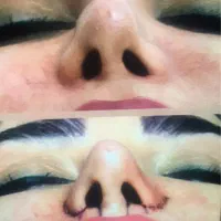 عمل بینی‌های باپره باز وگوشتی فقط12