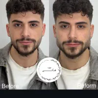 فیلر مادلینگ عربی و بوتاکس کرج