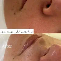فشیال تخصصی واصلاح تخصصی درماپلینگ|خدمات آرایشگری و زیبایی|بیرجند, |دیوار