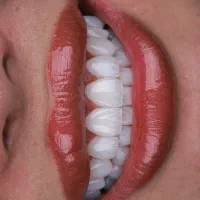 کامپوزیت دندان روش لیرینگ با ضمانت|خدمات آرایشگری و زیبایی|مشهد, فلسطین|دیوار