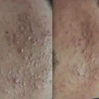 تخفیف یک هفته ای پاکسازی و‌فیشال‌خانوم ها و اقایون