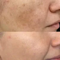 حذف لک و خال در یک جلسه|خدمات آرایشگری و زیبایی|پاکدشت, حصار امیر|دیوار