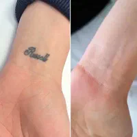 پاک کردن تتو با لیزر تخصصی