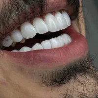کامپوزیت فکی ۵۹۰۰|خدمات زیبایی و سلامت|تهران, جنتآباد جنوبی|دیوار