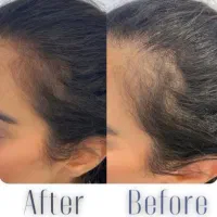 در افسریه ژل و فیلر مزوتراپی چربی سوز غبغب جوانساز|خدمات آرایشگری و زیبایی|تهران, افسریه شمالی|دیوار