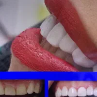 ایمپلنت ارتودنسی لمینت کامپوزیت