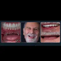 مرکز تخصصی ایمپلنت با اقساط ویژه