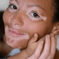 درمان انواع بیماریهای پوستی|آرایشی، بهداشتی، درمانی|شاهرود (اردبیل), |دیوار