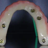 روکش تمام سرامیک ودندان مصنوعی