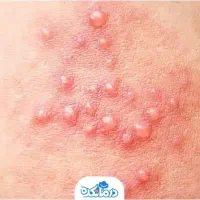 زگیل تناسلی|آرایشی، بهداشتی، درمانی|یاسوج, |دیوار