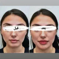 بوتاکس،فیلر،مادلینگ صورت،انواع جوانساز|خدمات آرایشگری و زیبایی|کرمانشاه, |دیوار
