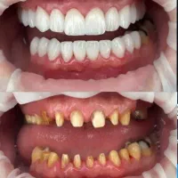 جشنواره کلیه خدمات دندانپزشکی با اقساط ۱۵ ماهه