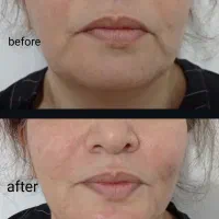 تخفیف بوتاکس و ژل