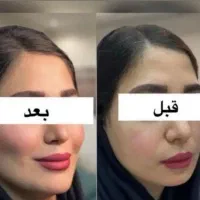 بوتاکس 8۵۰ژل اودری ۶۵۰نخ لاغری وآنزیم ۱۴۰۰چربی