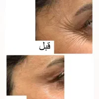خدمات ژل بوتاکس آنزیم  فیلر جوانساز مرو سر ابرو