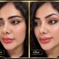 ساکشن بلفارو دایرکت با تخفیف وشرایط