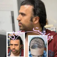 کاشت مو جانا