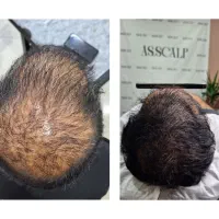 میکرو اسکالپ مکمل کاشت مو