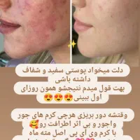 کرم ضد لک و ضدجوش و تیرگی