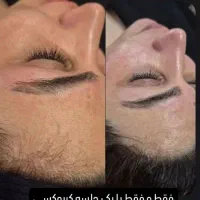 خدمات و آموزش فیشیال مزوتراپی میکروندلینگ|خدمات آرایشگری و زیبایی|اهواز, حصیرآباد|دیوار