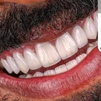 جشنواره کامپوزیت ونیر لمینیت روکش عصب ترمیم IMAX