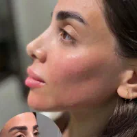 تخفیفات استثنایی ژل و بوتاکس در مطب زیبایی|خدمات آرایشگری و زیبایی|قم, زنبیل آباد|دیوار