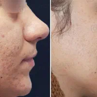 آف چربی بوتاکس ساکشن غبغب ژل مزو PRP، پزشک مجرب|خدمات آرایشگری و زیبایی|زاهدان, |دیوار