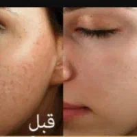 مزونیدلینگ صورت بصورت حرفه ای تضمین صد درصد درمان