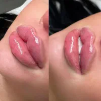 ژل لب فقط۷۹۸/بوتاکس۸۸۸/ فشیالVIP/ لیزرفول بادی ۷۵۰